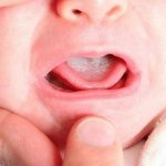 Thrush in children&#39;s mouth