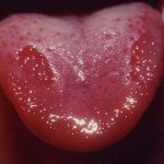 The photo shows glossitis of the tongue