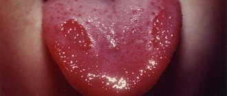 The photo shows glossitis of the tongue