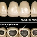 The picture shows the thickness of metal-ceramic crowns