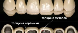 The picture shows the thickness of metal-ceramic crowns