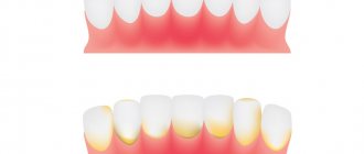 The initial stage of gingivitis is tartar