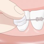 Applying orthodontic wax to braces.