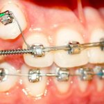 External braces are one of the main (for now) methods of orthodontic treatment for correcting malocclusion in adults.