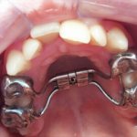 palatal expander