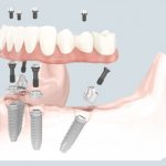 Fixed prosthesis all-on-4