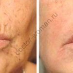 Rejuvenation of the skin around the mouth using mesotherapy before and after