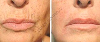 Rejuvenation of the skin around the mouth using mesotherapy before and after