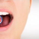 Mouth rinses for periodontitis