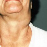 Tumors and swellings in the neck area