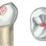 Features of superficial caries