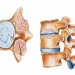 Osteochondrosis of the cervical spine.jpg