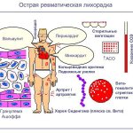 Острая ревматическая лихорадка