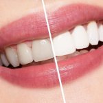 Whitening before and after