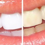 Teeth whitening