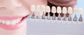 Teeth whitening