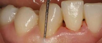 open curettage of periodontal pockets