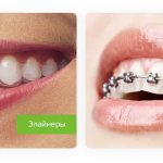 differences between aligners and braces