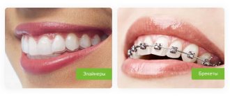 differences between aligners and braces