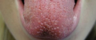 tongue burns treatment