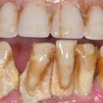 periodontitis