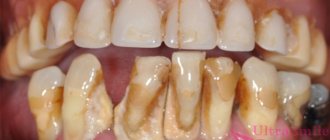 periodontitis