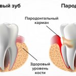 Пародонтит