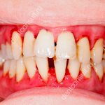 periodontitis