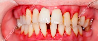 periodontitis