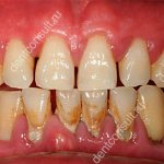 periodontitis