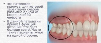 Перекрестный прикус