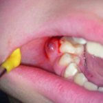 Periapical pathologies: how to treat?