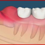 Pericoronitis