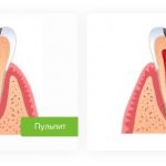 periodontitis and pulpitis