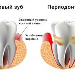 periodontitis