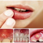 periostitis