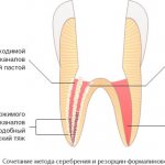 пломбирование корневого канала сочетанием метода серебрения и резорцин-формалинового метода