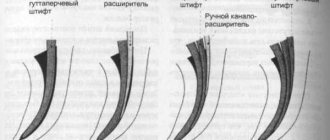 Root canal filling using lateral condensation method