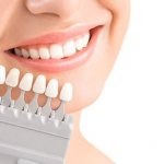 Preparing teeth for whitening