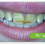 indications for artistic dental restoration