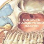 Maxillary sinus cavity