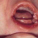 Infection of the oral mucosa of a child with thrush