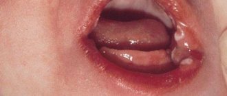 Infection of the oral mucosa of a child with thrush