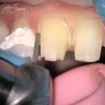 Tooth preparation for durable crown fixation