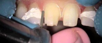 Tooth preparation for durable crown fixation