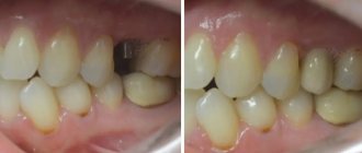 example of the result of dental prosthetics