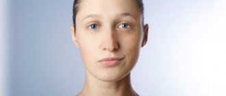 acquired facial asymmetry