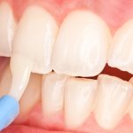 Teeth fluoridation procedure