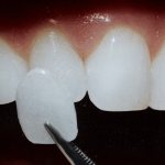 The process of tooth restoration by installing a composite veneer