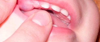 Teething of molars in children: symptoms